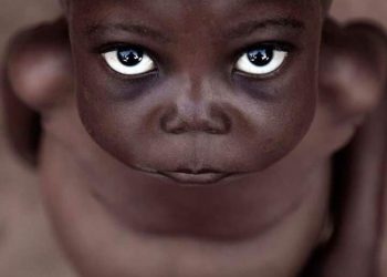RDC : 2,5 millions d&rsquo;enfants en situation de malnutrition aiguë