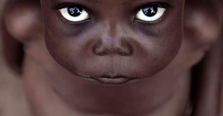 RDC : 2,5 millions d&rsquo;enfants en situation de malnutrition aiguë