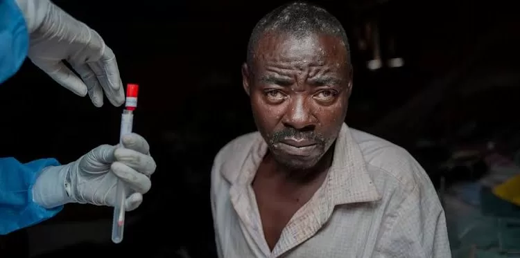 RDC : 200 000 doses de vaccin contre la variole du singe reçues