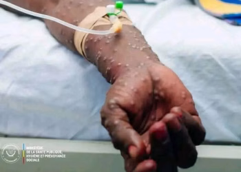 RDC – Épidémie de Mpox : 527 nouveaux cas suspects et 9 décès enregistrés durant la semaine S20 de 2025