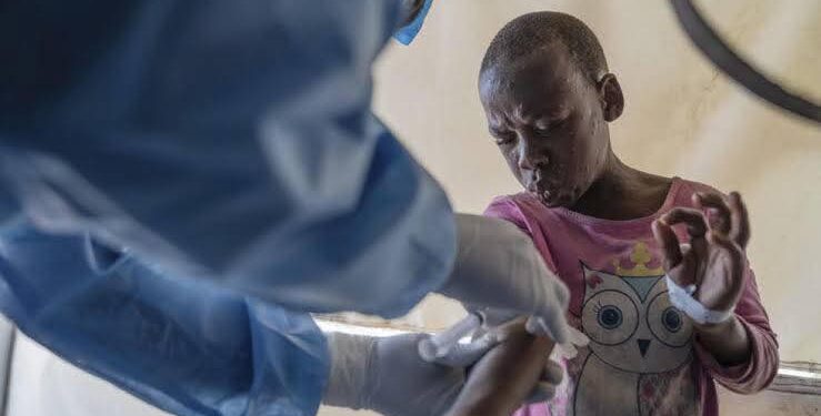 RDC : Mpox et choléra sous haute surveillance