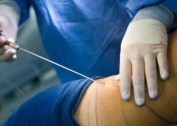 RDC – Le grand coup de frein du gouvernement : Aucune clinique n’est autorisée à pratiquer le BBL