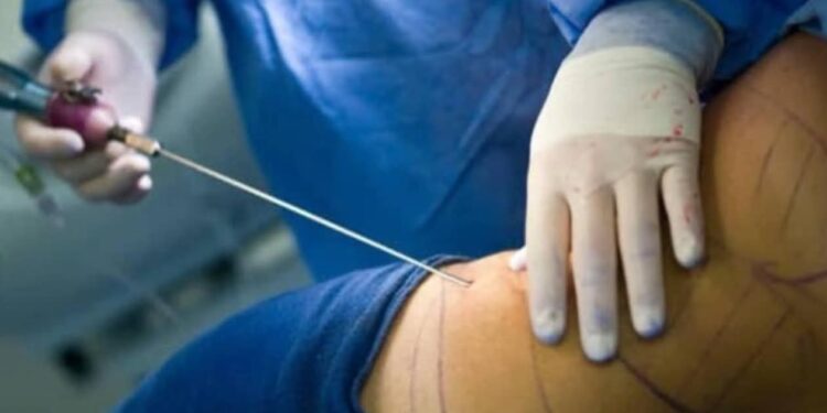 RDC – Le grand coup de frein du gouvernement : Aucune clinique n’est autorisée à pratiquer le BBL