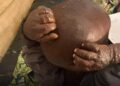Mpox au Kasaï : 22 cas suspects signalés à Luebo, trois décès