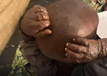 Mpox au Kasaï : 22 cas suspects signalés à Luebo, trois décès