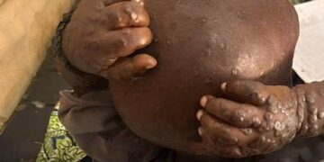 Mpox au Kasaï : 22 cas suspects signalés à Luebo, trois décès
