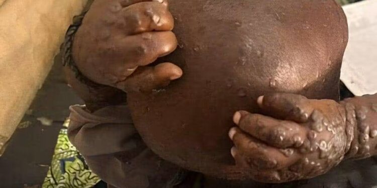 Mpox au Kasaï : 22 cas suspects signalés à Luebo, trois décès
