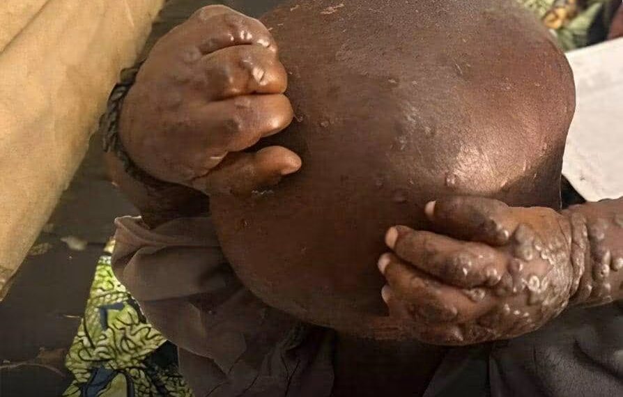 Mpox au Kasaï : 22 cas suspects signalés à Luebo, trois décès