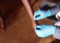 Kasaï : suspicion de Mpox à Luebo, aucune confirmation à ce stade