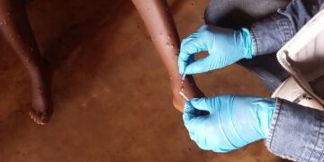 Kasaï : suspicion de Mpox à Luebo, aucune confirmation à ce stade